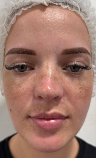before-peeling
