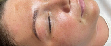 after-peeling
