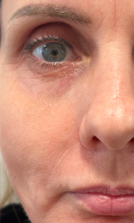 after-peeling