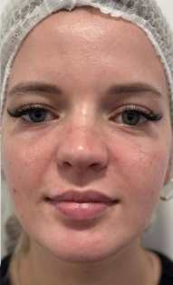 after-peeling